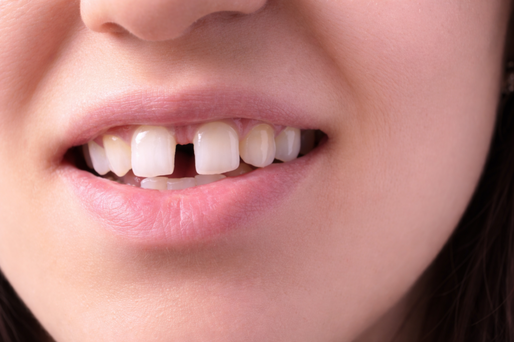 Top orthodontist for braces in Guntur Root canal expert doctor in Guntur Tooth cap treatment cost in Guntur Permanent teeth fixing clinic in Guntur